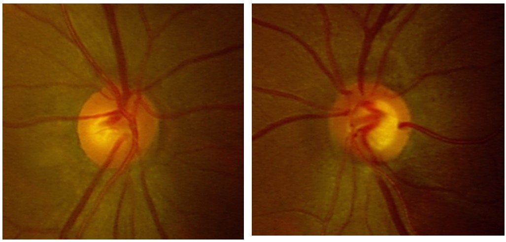 Eye doctor providing glaucoma management at Vihaan Eye Care