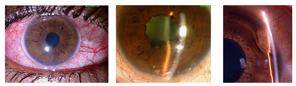 Uveitis Treatment by Specialist at Vihaan Eye Care